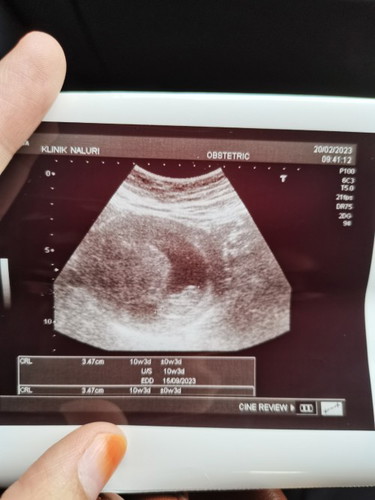Fibroid semasa hamil