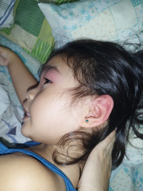 anong gamot po ang pwede ilagay sa kagat ng insect? not sure kung ano pong insect naka dapo kay baby