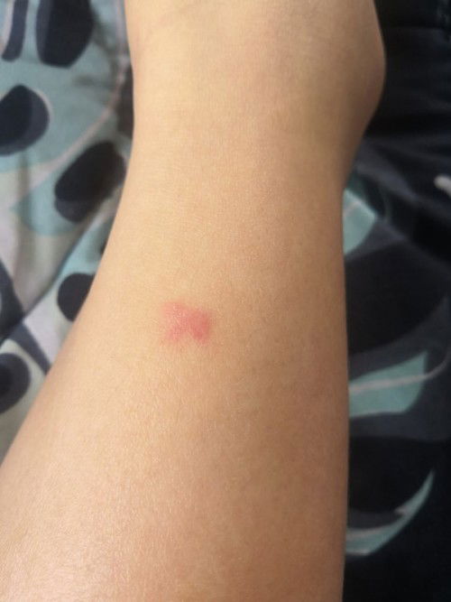 Alergik kehamilan 15w3d