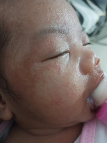 Gamot sa baby acne