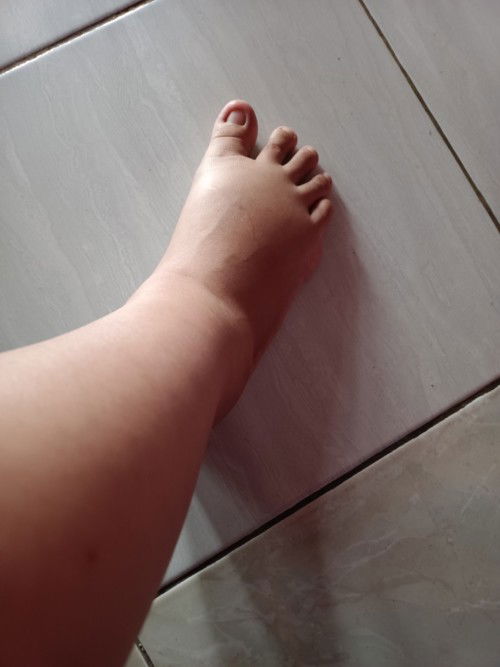 Kaki bengkak usia kehamilan 35 w 3 hari .