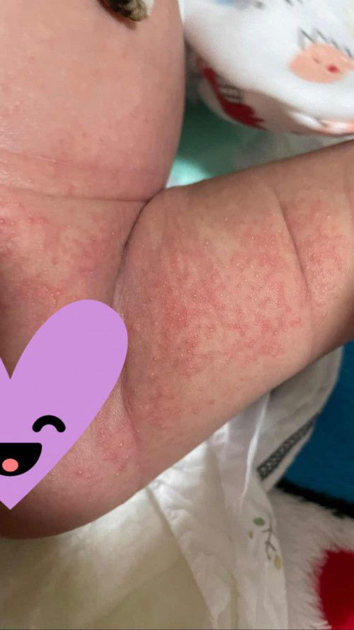 ผื่นแบบนี้ต้องไปหาหมอไหม?