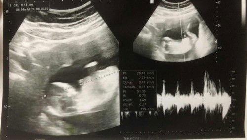 14w1d หน้าท้องหนา u/s ไม่ชัด