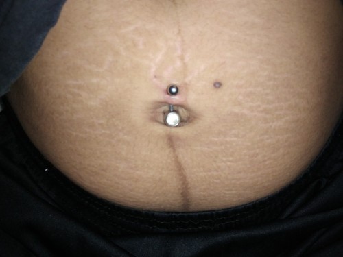 แนะนำครีมลดรอยแตก