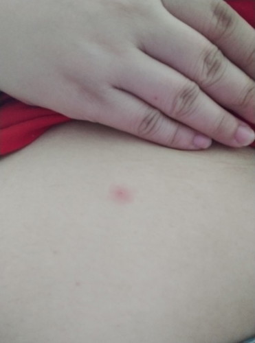 Itchy rashes