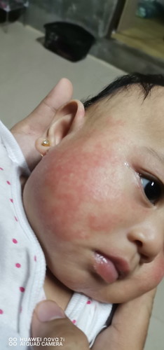 rashes sa mukha ni baby