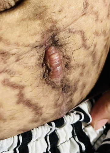 Normal po ba to sa 1month cesarean scar?