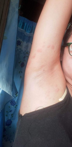 Normal lng ba sa buntis ang magkaroon ng prang kati2 at kumklat din siya sbrang kati rin nya.
