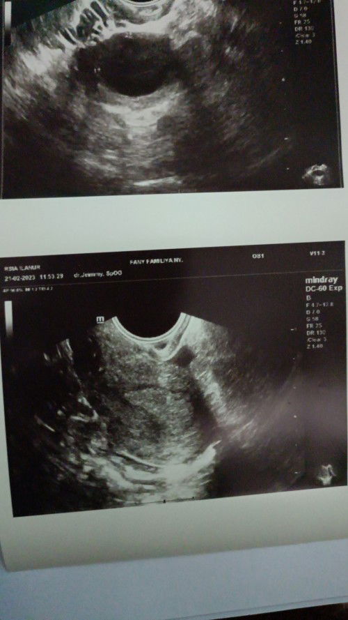 Minggu ke 4 tapi keluar darah haid