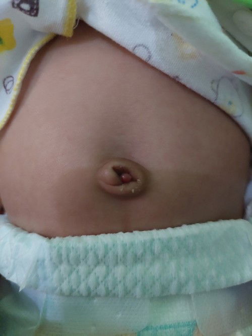 Tanya tentang udel si bayi