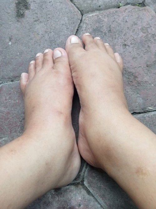 31 week kaki sering bengkak