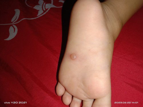 Kaki anak saya bintil berair
