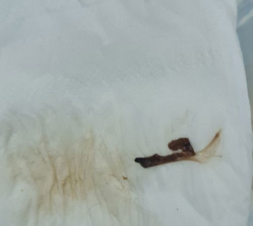 ตั้งครรภ์ได้4w มีตกขาวแบบนี้ออกมา จะเป็นอะไรไหมคะ