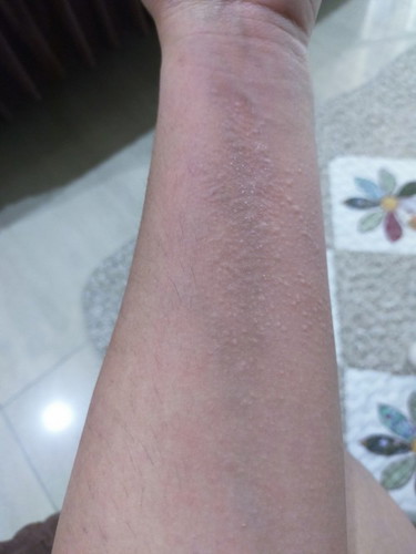 Hi, I am 28 weeks pregnant now, I have been having this rashes since yesterday, anyone can advise ?