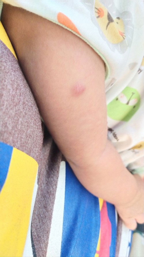 ปลูกฝีแขนขวา