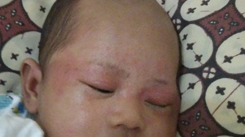 Mau nanyak dong mok anak saya kenapa ya daerah mukak nya merah beruntusan tapi kyknya ini merahbnget