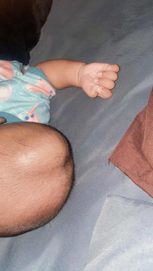 Benjolan dikepala bayi baru lahir
