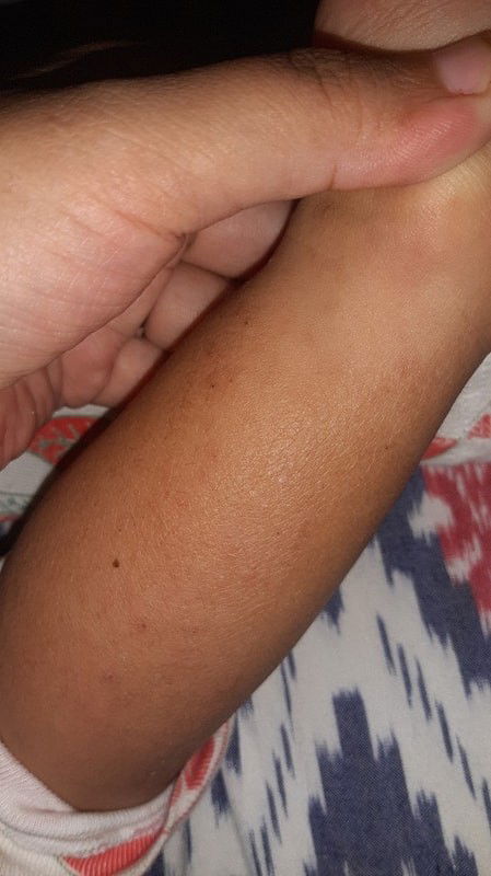 Kulit kering pada anak (20bln)