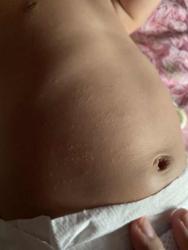 Bintik badan baby