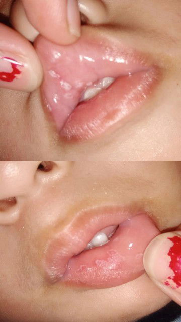 Bun ini kenapa ya mulut anak saya kira kira . Tapi ketika makan tidak mengeluh perih atau sakit