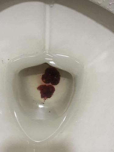 Bleeding atau gugur?