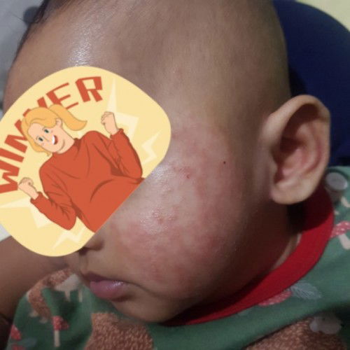 Ruam pipi merah dan kasar