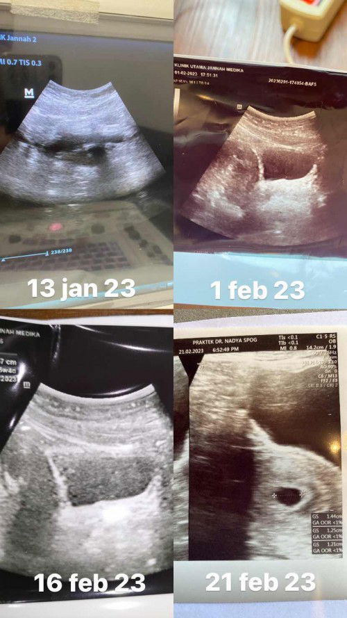 HASIL USG BERBEDA ITUNGANYA HPHT/KANTONG?