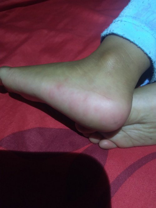 kaki & tangan bruntusan merah