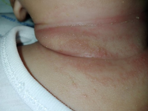 Rashes sa leeg ng 3 months baby ko