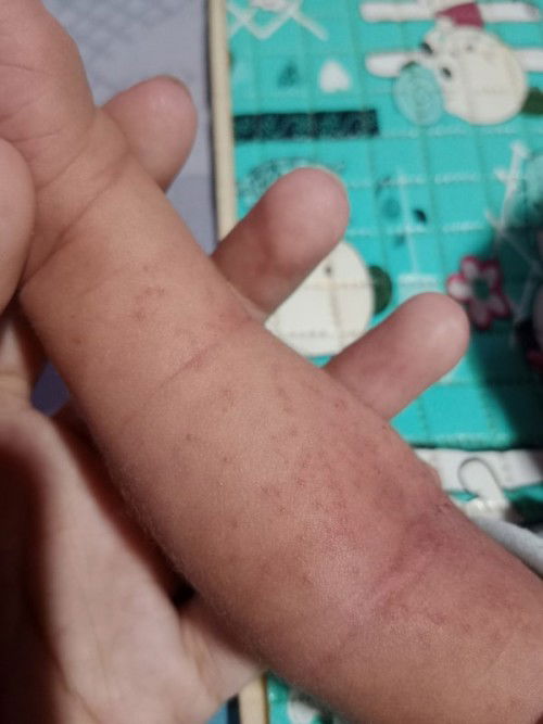 Bintik Merah di Kulit Newborn