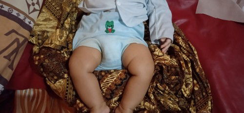 Paha besar sebelah pada bayi