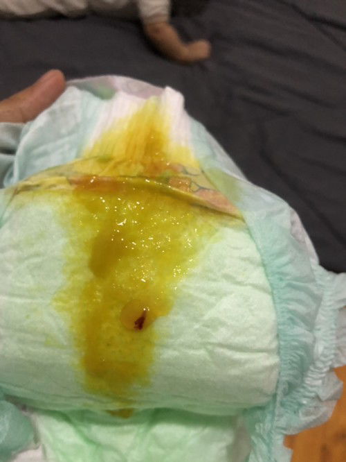 Bayi 4 bulan buang air besar ada darah