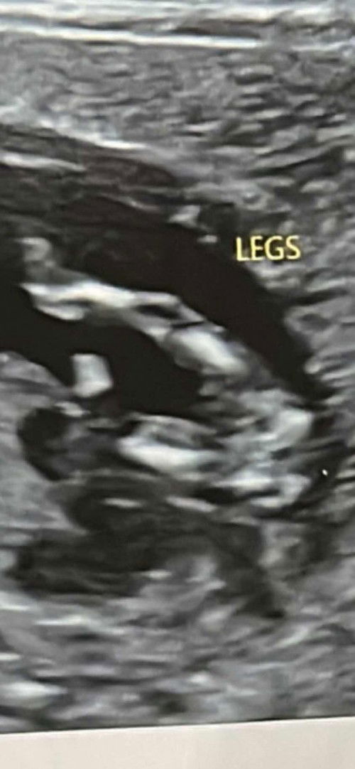 Too early to tell gender ? Week 12