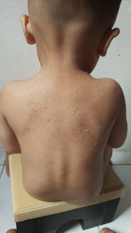 Solusinya bund, kira kira ada gak yang anaknya pernah ngalamin bentol2 beruntusan kecil kayak gini?