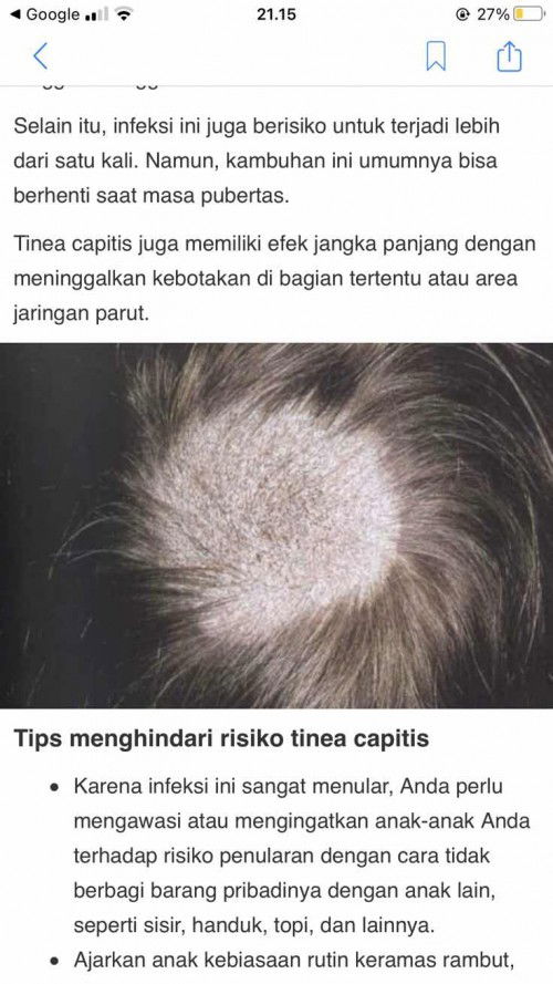 Gatal di kepala anak