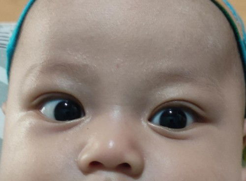 Mata Juling pada bayi