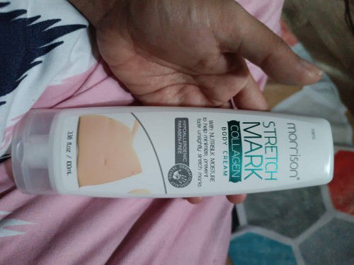 Morrison stretchmark