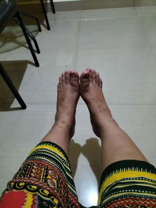 Gatal2 dikaki smpai berbekas ada tw apa bgus supya bs hilang atau mudar ?