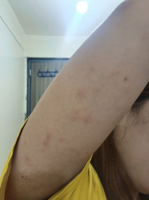 RASHES (15 WEEKS PREGNANT)