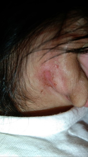 Infection??