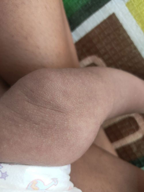 ลูกเป็นผื่นแบบนี้ ทำไงดีคะ