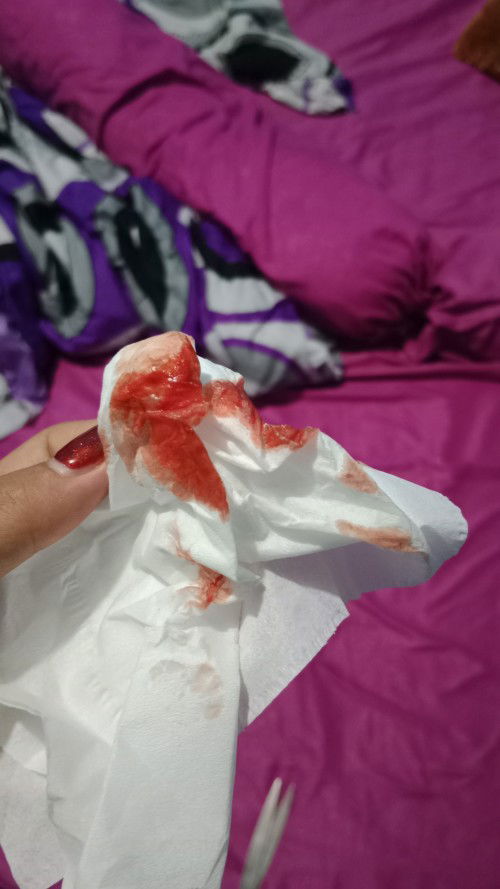 Flek di usia kehamilan 37w 5d