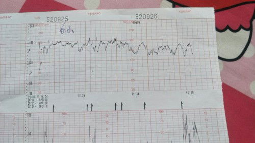 ฟังเสียงหัวใจเด็ก180 แบบนี้ปรกติมั้ยคะ