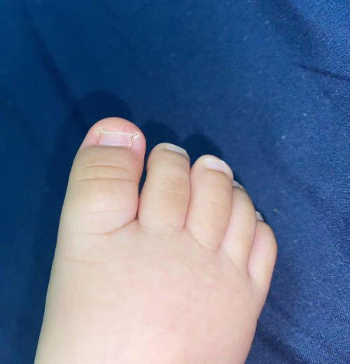 ลูกเป็นเล็บขบ