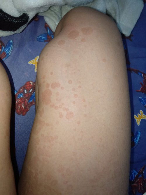 Bun ada ga yang semenjak hamil kulit nya jadi muncul bintik bintik gini. Tapi ga gatal bun