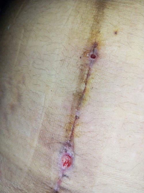 Mga mommy nagka nana din ba ang mga tahi niyo? 25days na ko mula nung ma CS. Pero nagkaganito.