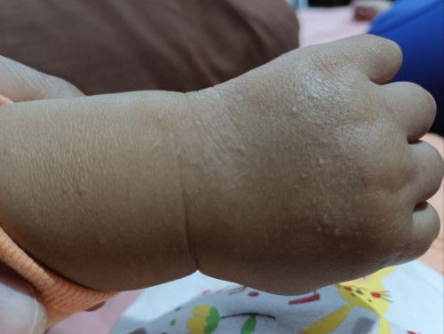 Salam.tangan ank sy kering dan brbiji2.losyen da sapu tp masih kulit kering LG.ada yg pernah alami🥲