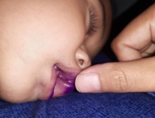 Sobek urat bagian atas mulut dan gusi