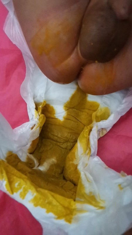 น้องท้องเสีย​ใช่​ไหมคะ