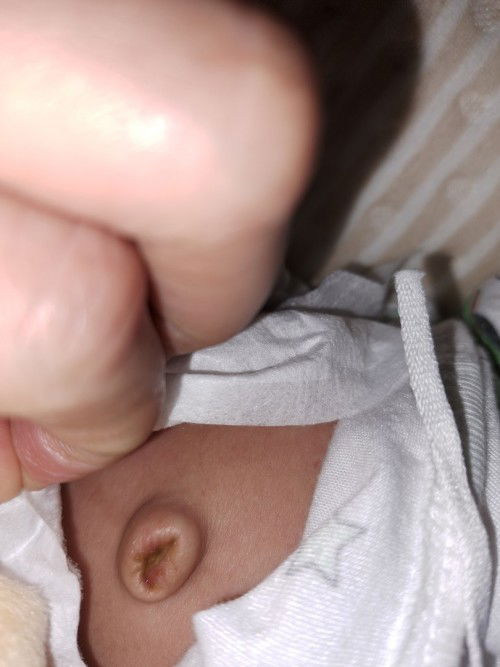 สะดือไม่แห้ง